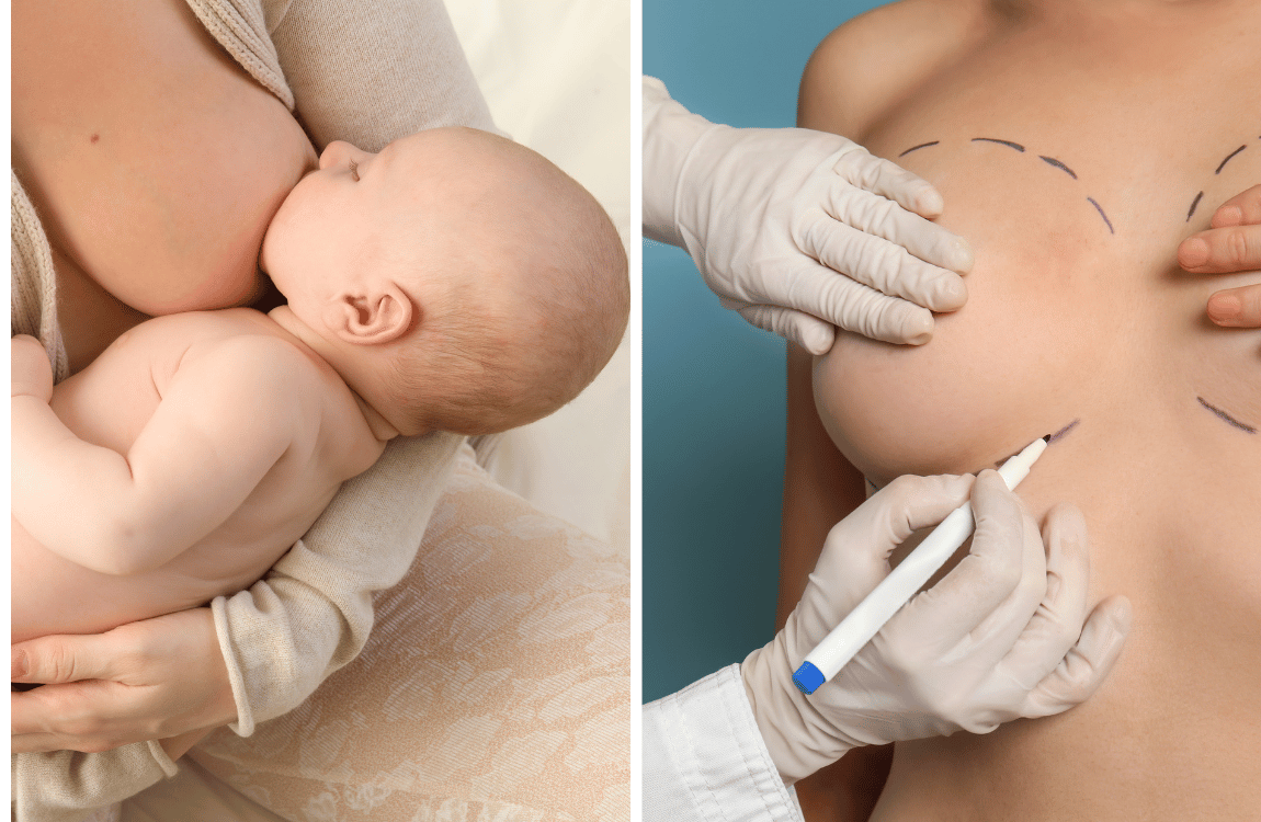 Can you breastfeed after a breast lift? What You Need To Do!